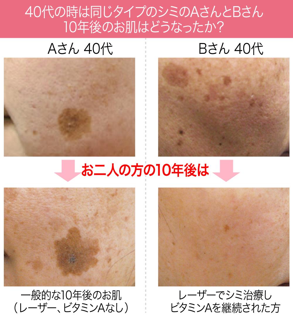 シミの原因と予防に役立つ食生活の見直しポイント