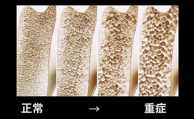 骨粗しょう症のリスクと予防ポイントを詳しく解説